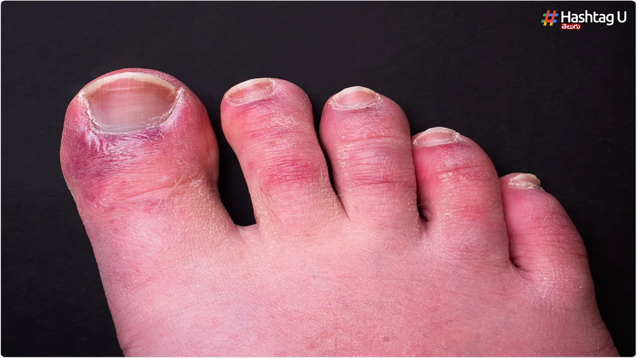 చలికాలంలో కాలి వేళ్ల మధ్య వచ్చే దురద, మంటను తగ్గించే చిట్కాలు,  పాటిస్తే అంతా క్లియర్