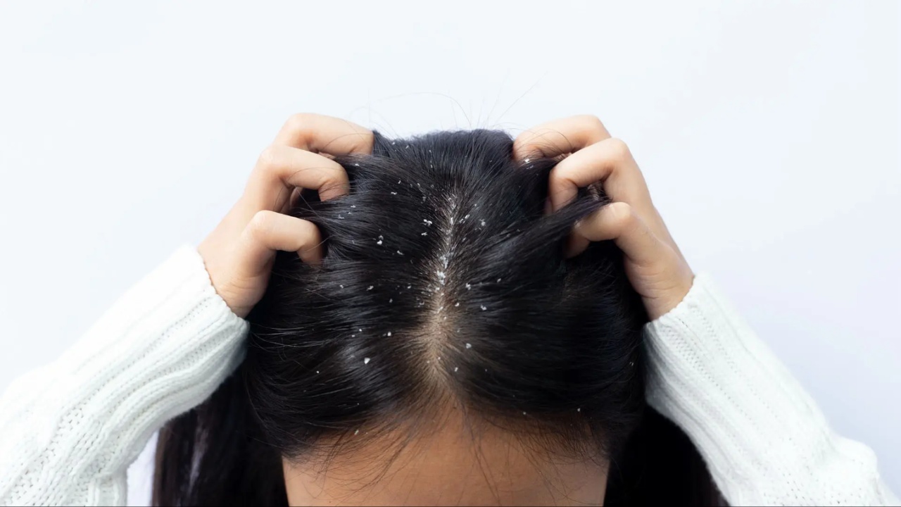 Winter Dandruff