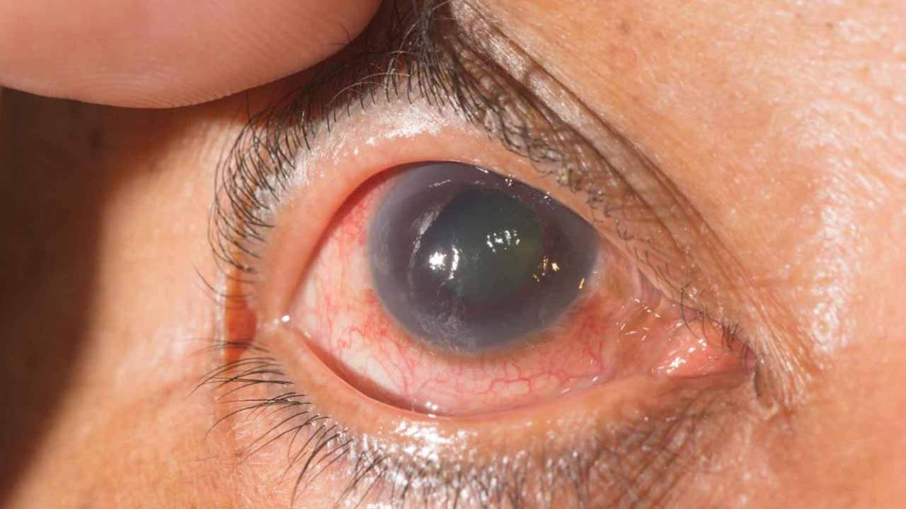 Secondary Glaucoma