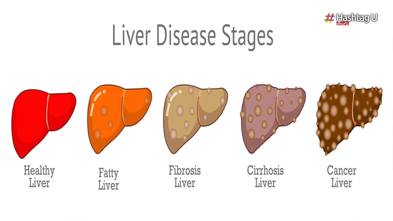 Fatty Liver Stages 