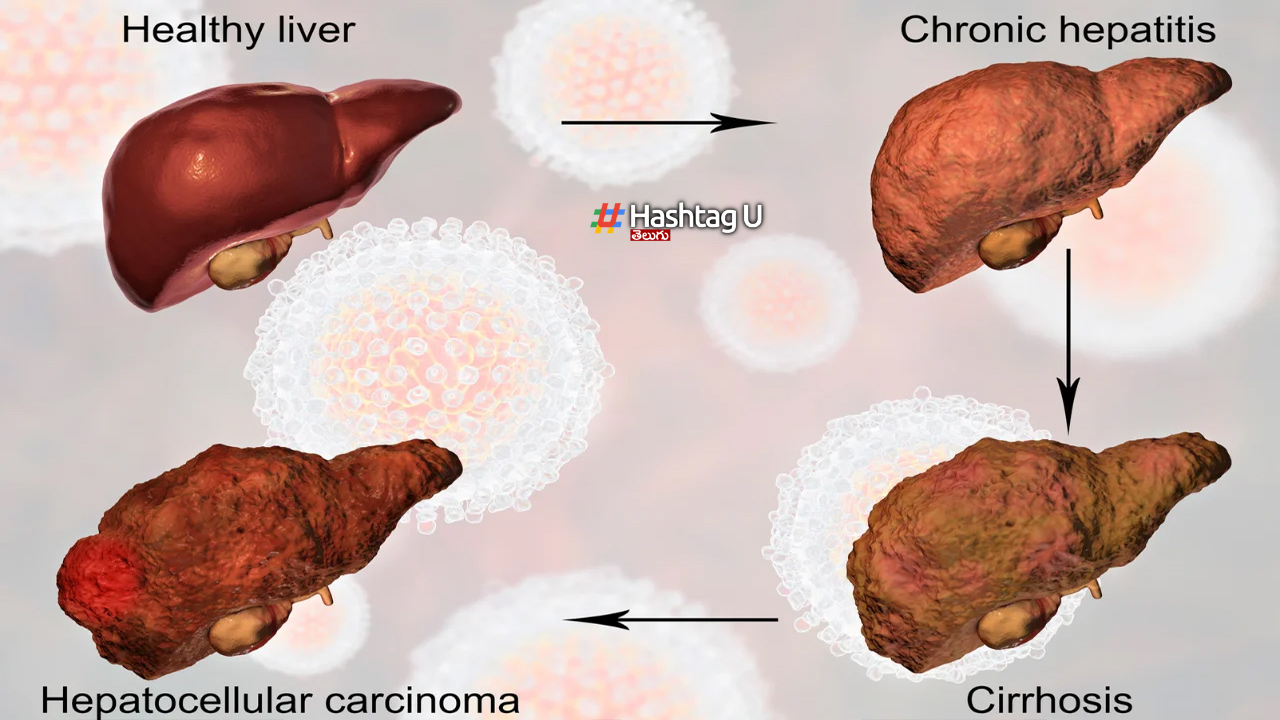 Fatty Liver Stages