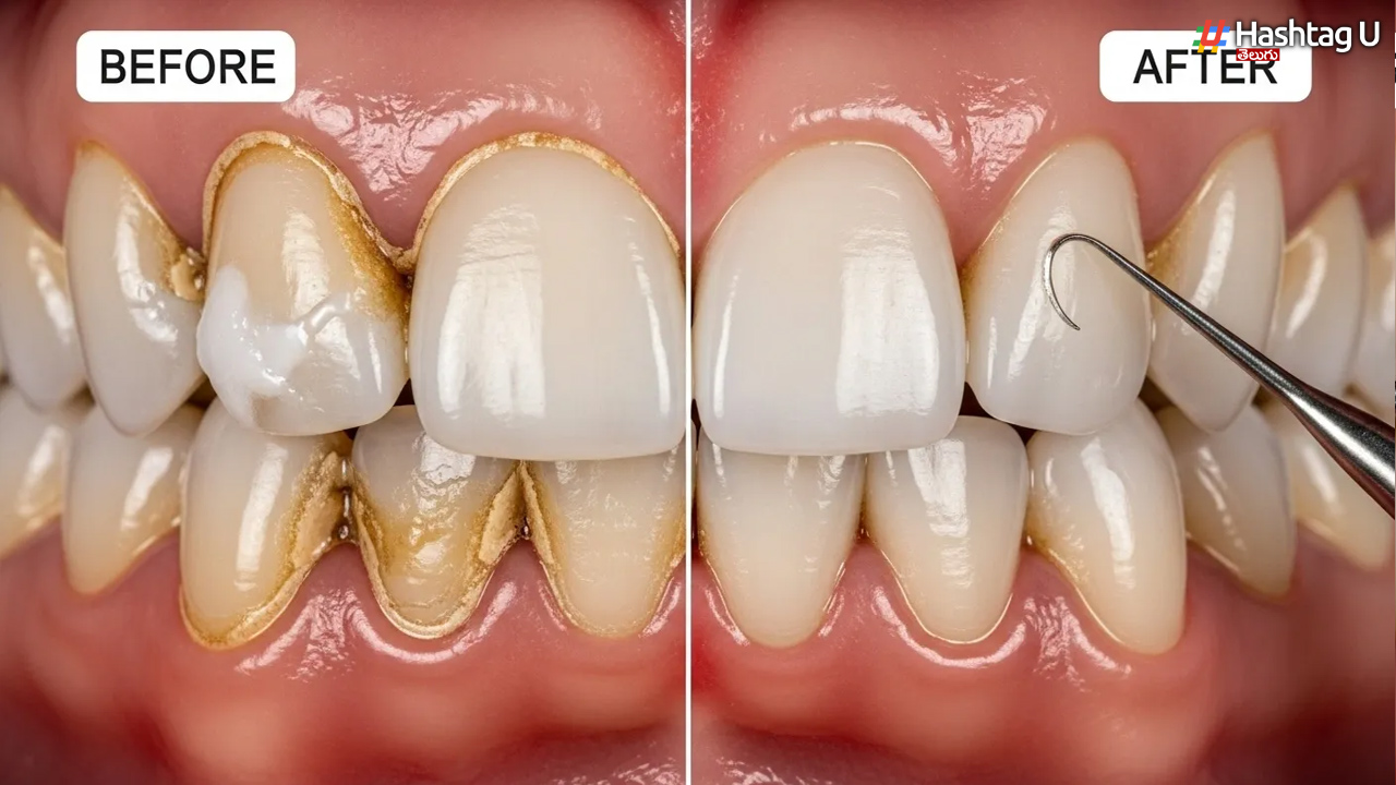 Yellow Teeth: పసుపు దంతాలకు అసలు కారణం ఇదే.. ఇలా చేస్తే మెరిసిపోవాల్సిందే