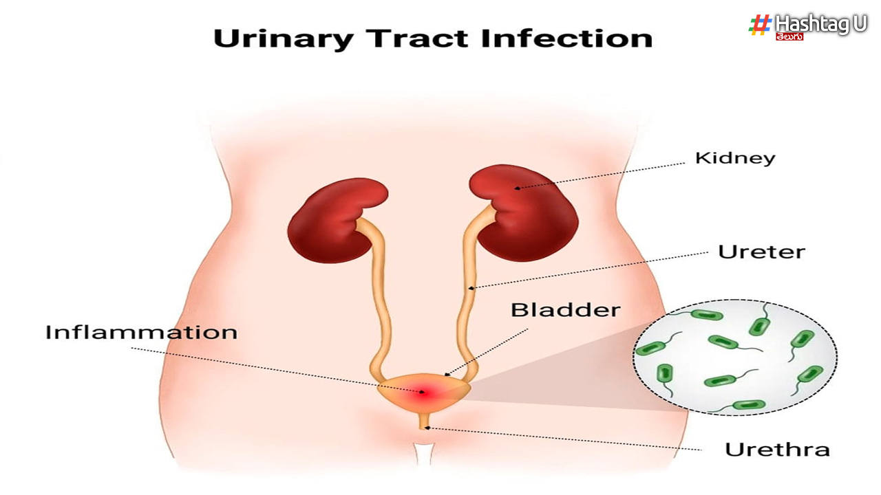 Urinary tract infection: మూత్రనాళాల ఇన్ఫెక్షన్‌కు పెరుగుతో చెక్.. ఎలాగో తెలుసుకోండి!