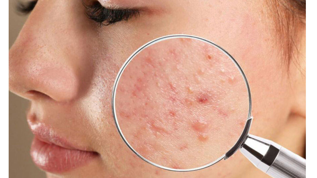 Pimples